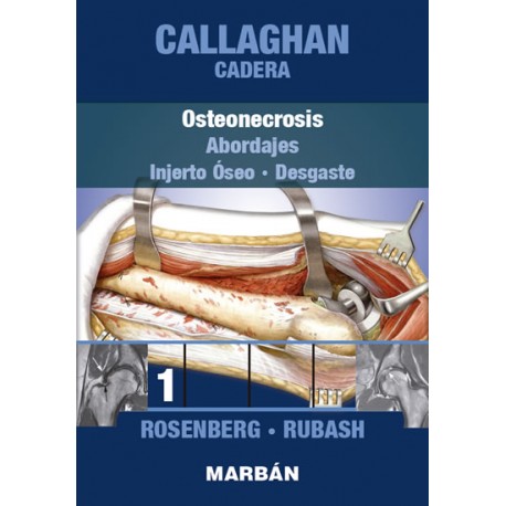 Callaghan - Cadera. Tomo 1: Osteonecrosis, Injerto Óseo,... 